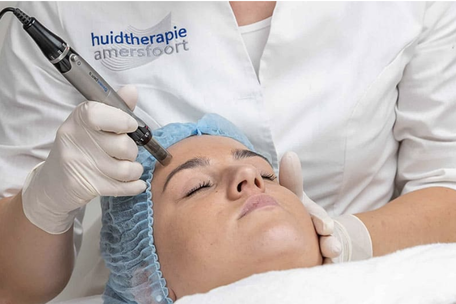 Microneedling Microneedling