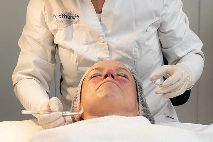 Rosacea behandeling Rosacea behandeling
