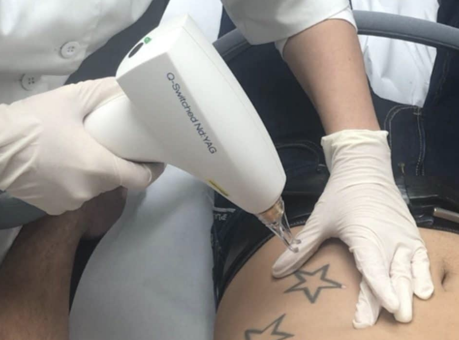 Tatoeage verwijderen Tatoeage verwijderen