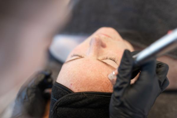 Microneedling Microneedling